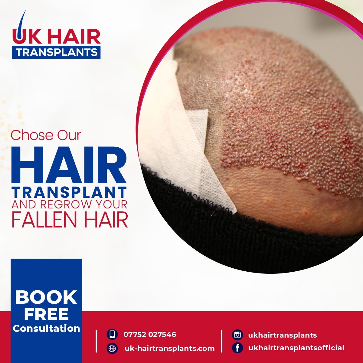 HAIR TRANSPLANT OR WIG? WHICH ONE IS BETTER FOR YOU? by UK Hair