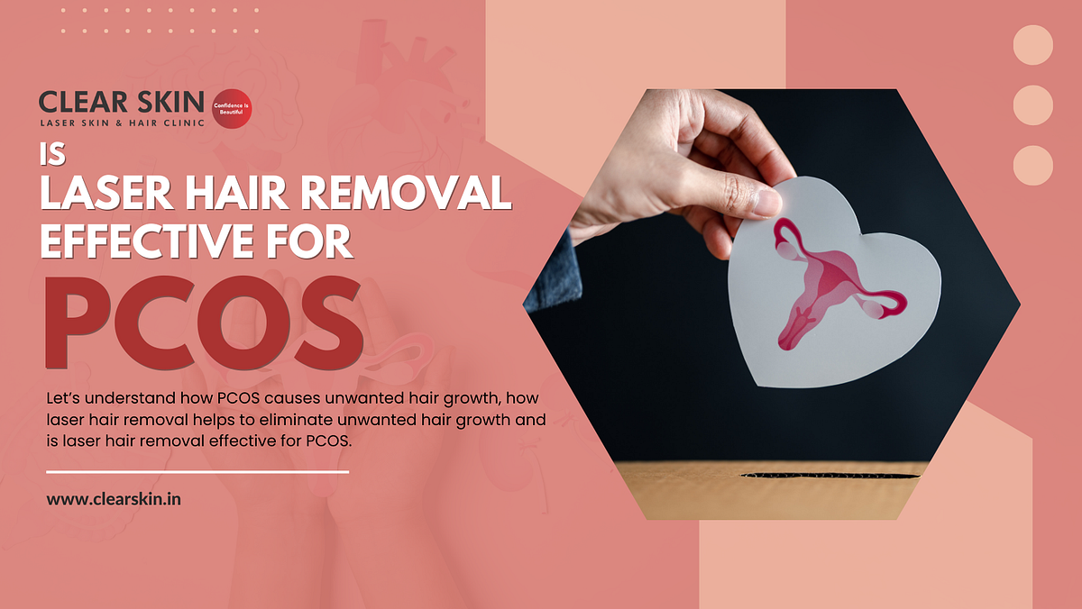 Is Laser Hair Removal Effective for PCOS? by ClearSkin Laser Skin
