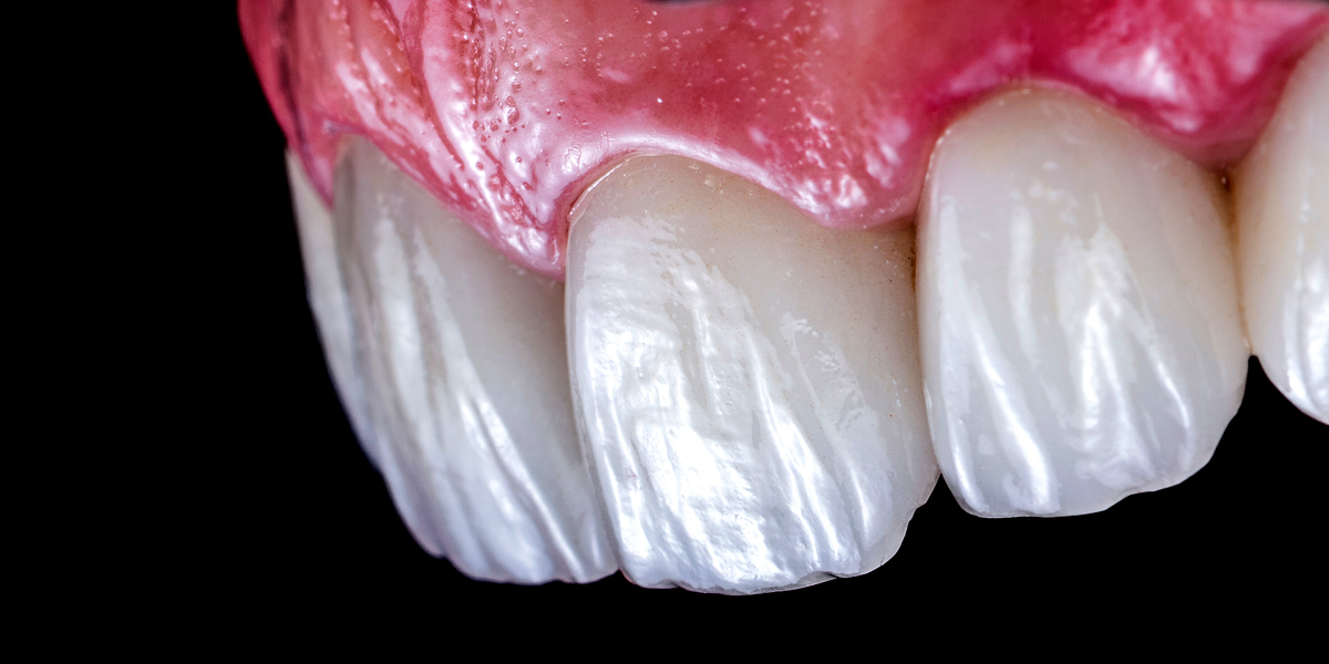 Porcelain Veneers How To Achieve A Perfect Smile In Just One Visit