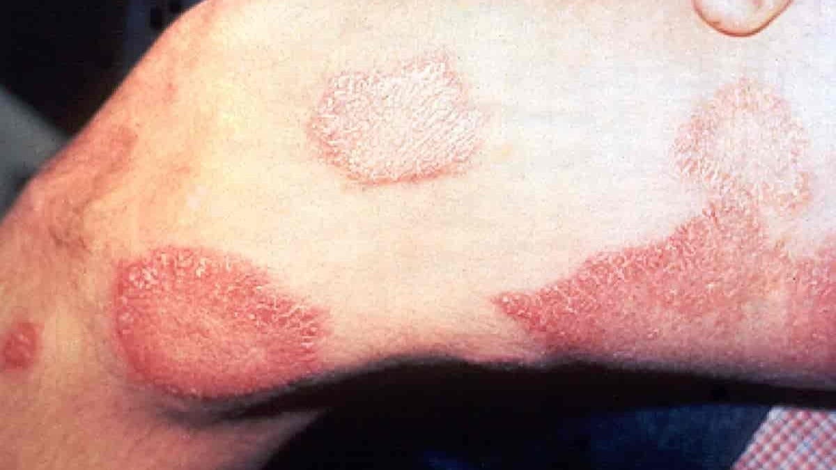 Leprosy’s Rising Spread in Florida: Armadillos & Soil Exposure Raise Concerns