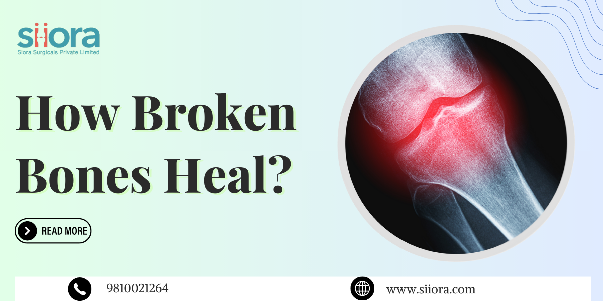 How Broken Bones Heal? Siora Surgicals Pvt Ltd Medium