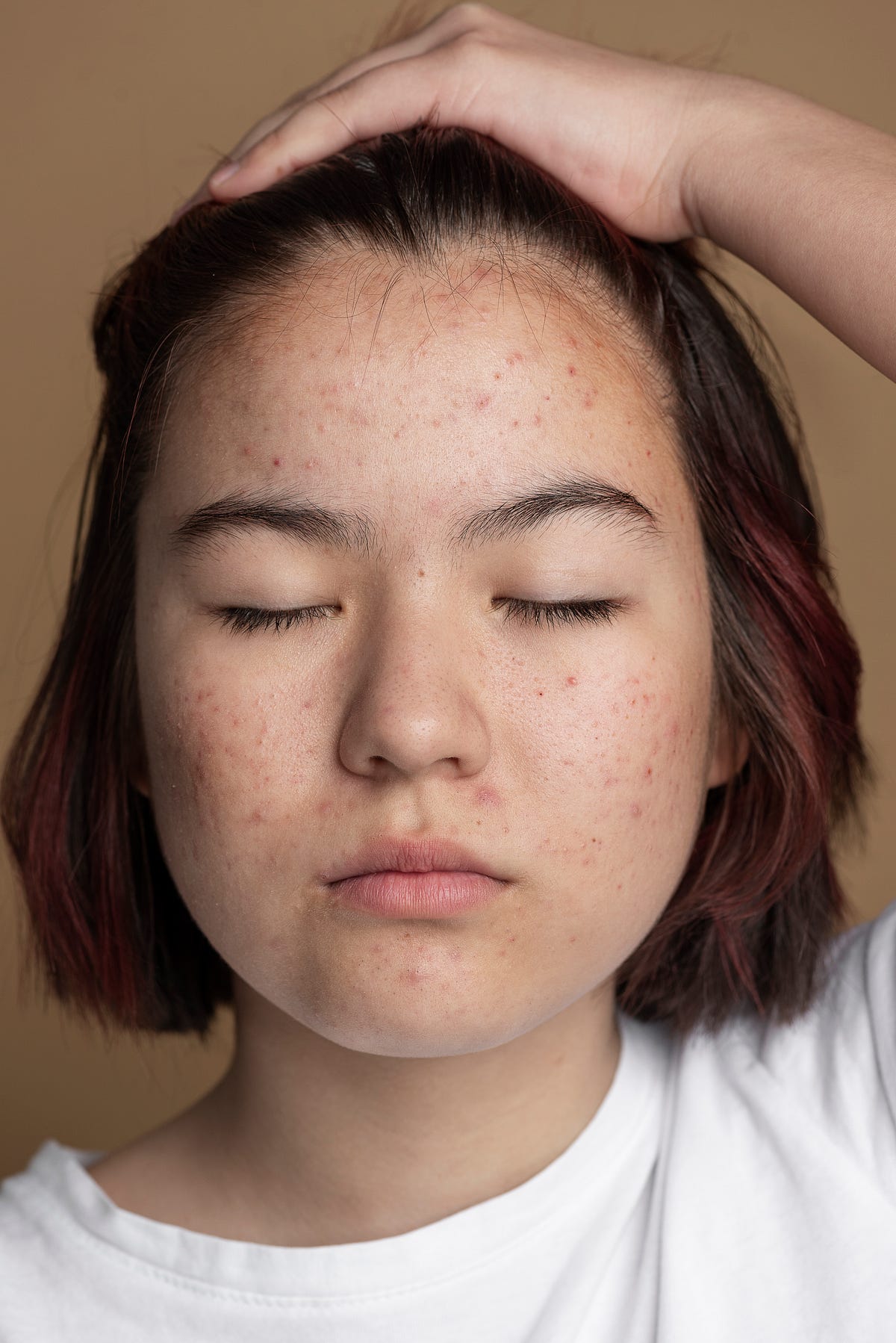 How to Prevent Acne Scars Best Practices for Managing Acne Breakouts