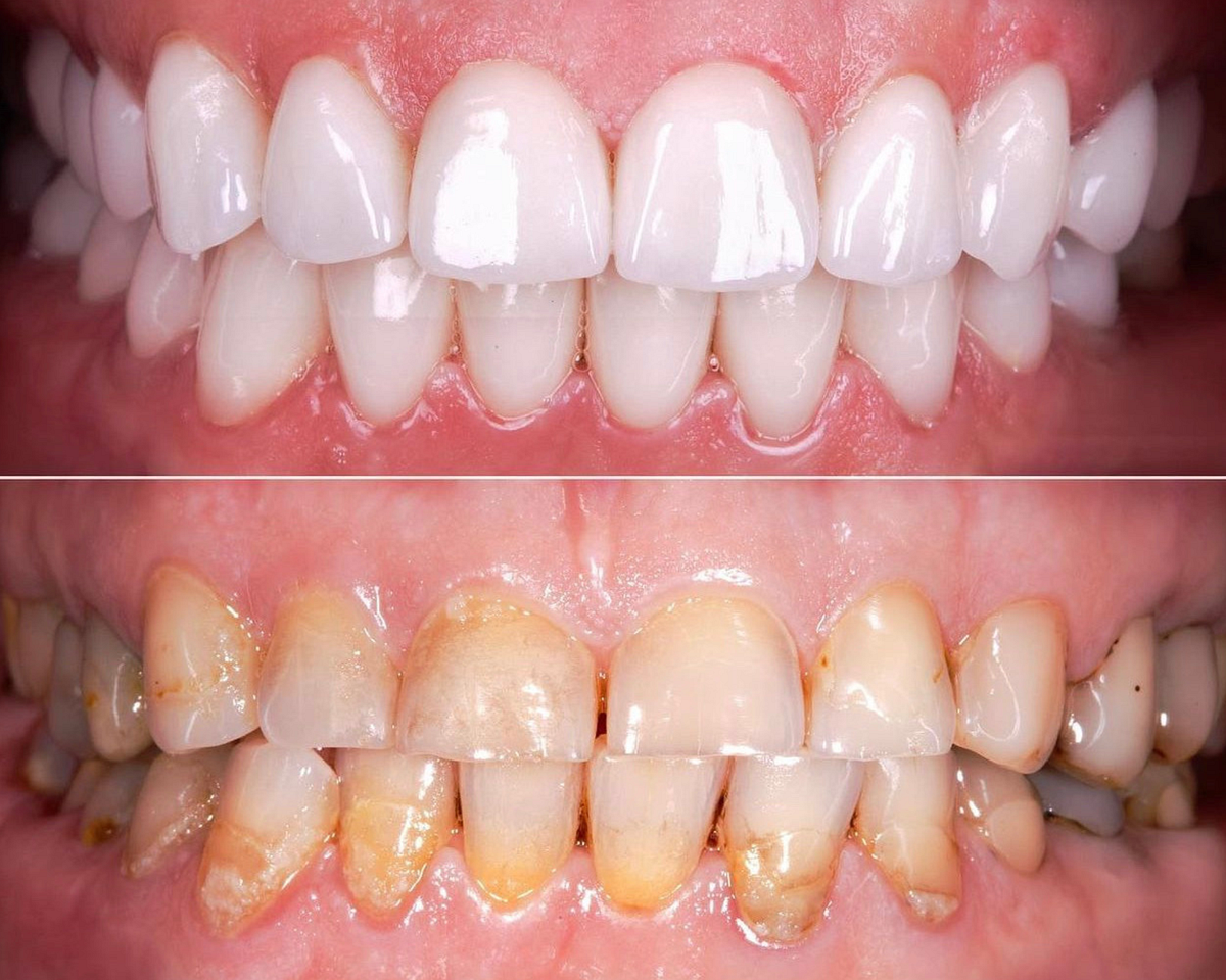Get Teeth Whitening Services Near Summerville Old Trolley Dental