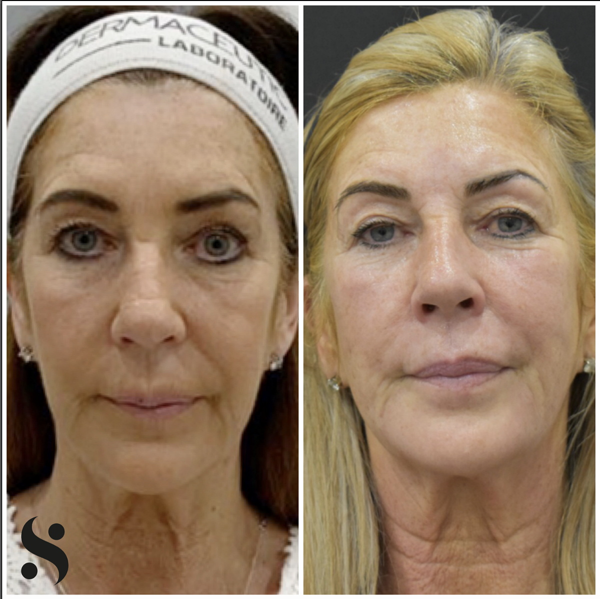 What exactly is skin tightening? Does radio frequency skin tightening