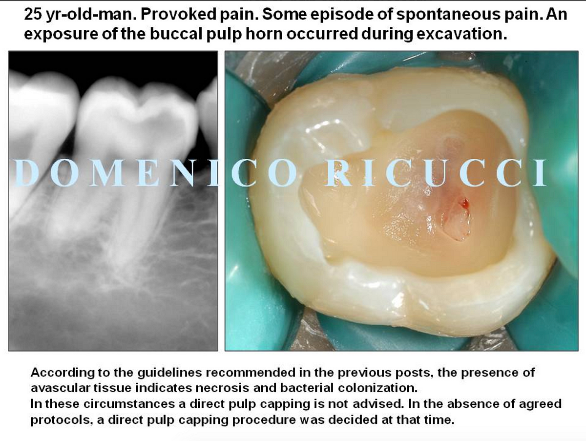 3. Failures of direct pulp capping | by Ashley Mark | Medium