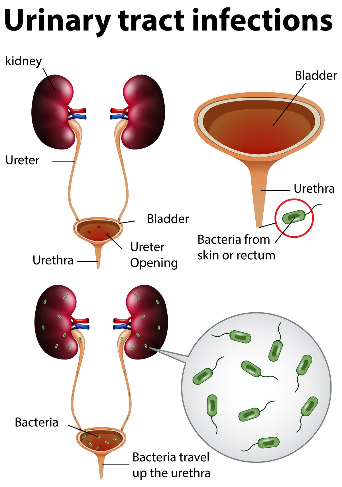 Understanding the Causes of Burning Sensation During Urination by