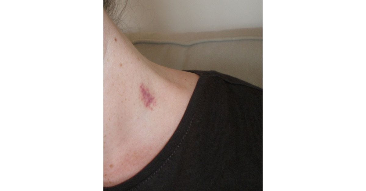 8 Tips On How To Get Rid Of Hickeys by Trendingfastindia Medium