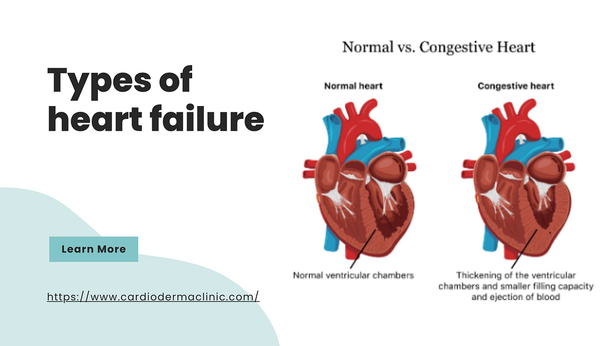 Types of heart failure. In heart failure, the heart can no… by