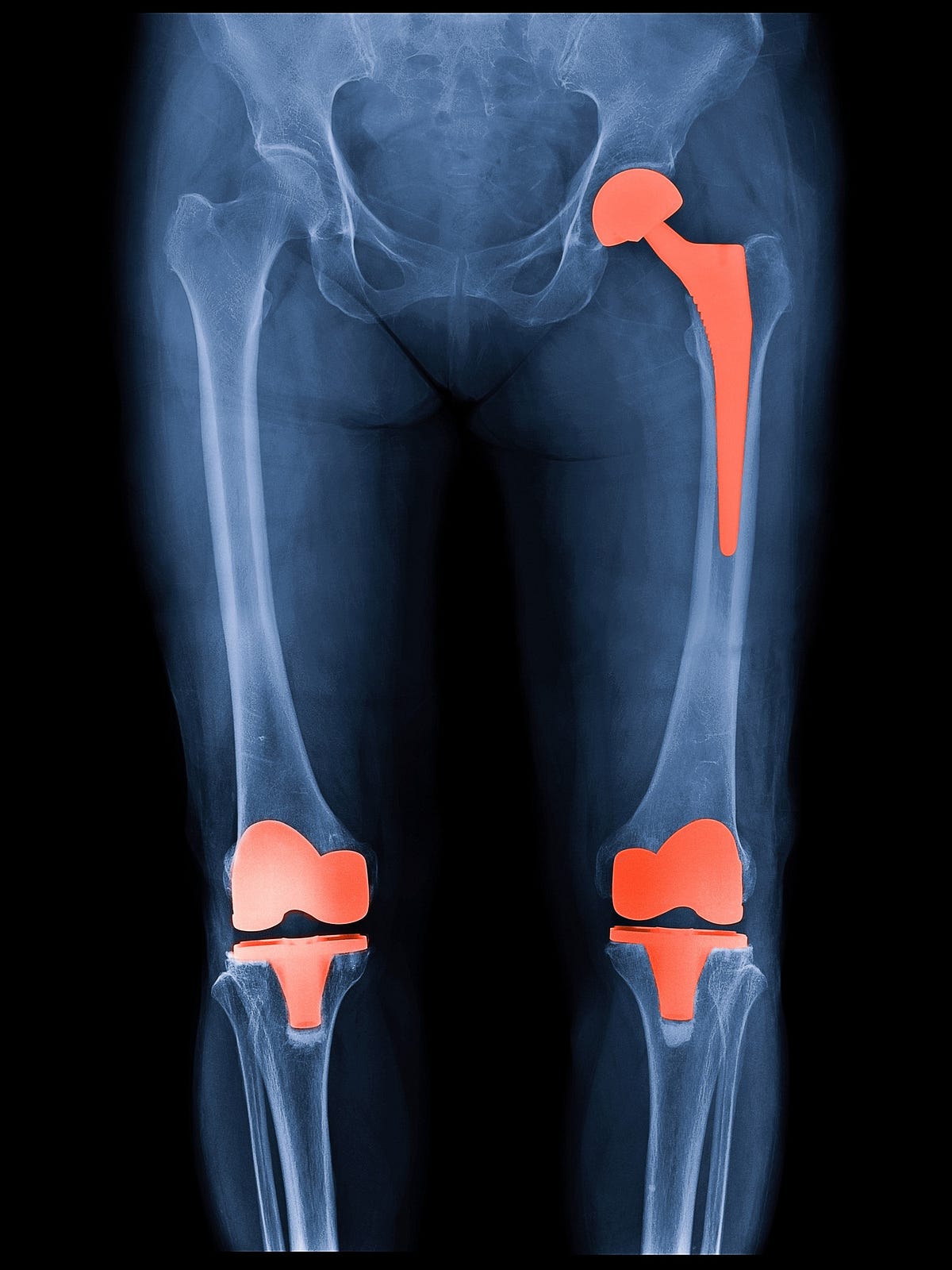 How long do knee replacements typically last? by Dr. Akash agarwal