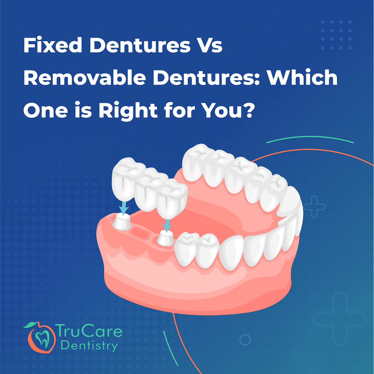 A Comparison between Fixed Dentures and Removable Dentures by Toral