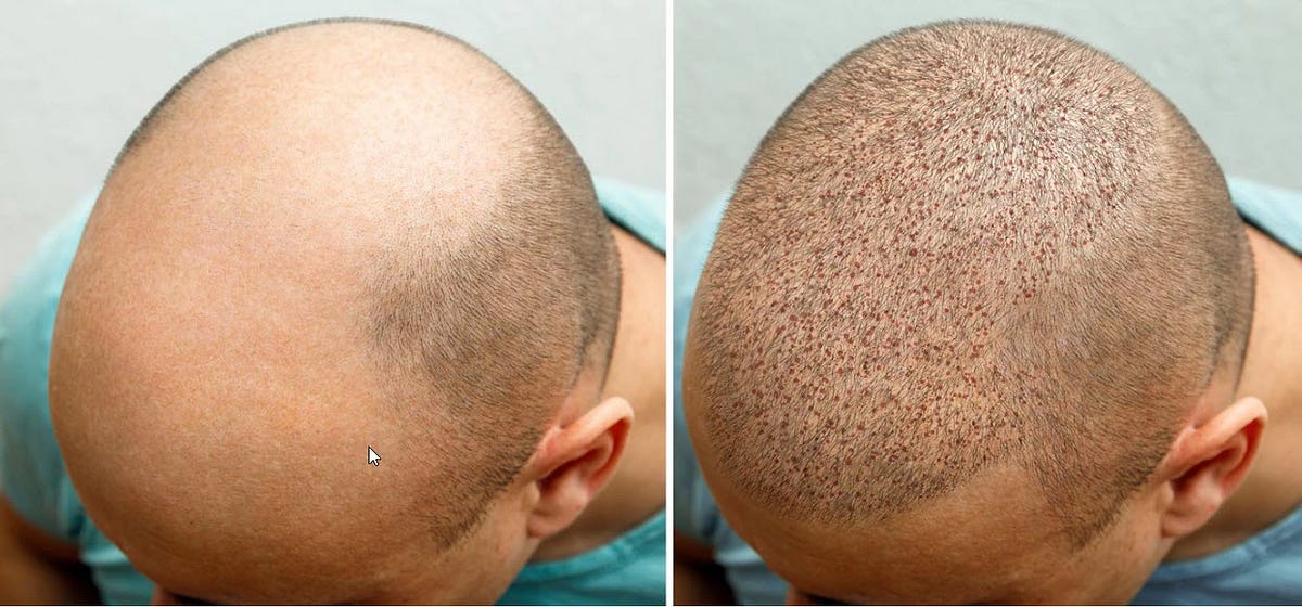 نصائح ما بعد زراعة الشعر. إن فترة ما بعد زراعة الشعر في تركيا… | by Raneem  Mustafa | Medium