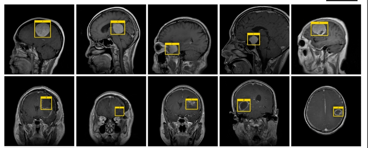 Brain Tumor Localization and Detection from MRI Images Using YOLOv8 ...