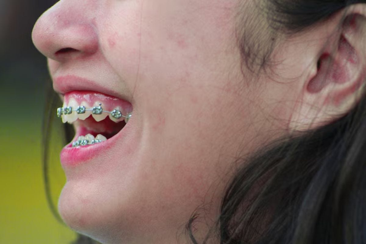 How Do Braces Fix Jaw Alignment?. Learn how braces work to correct jaw