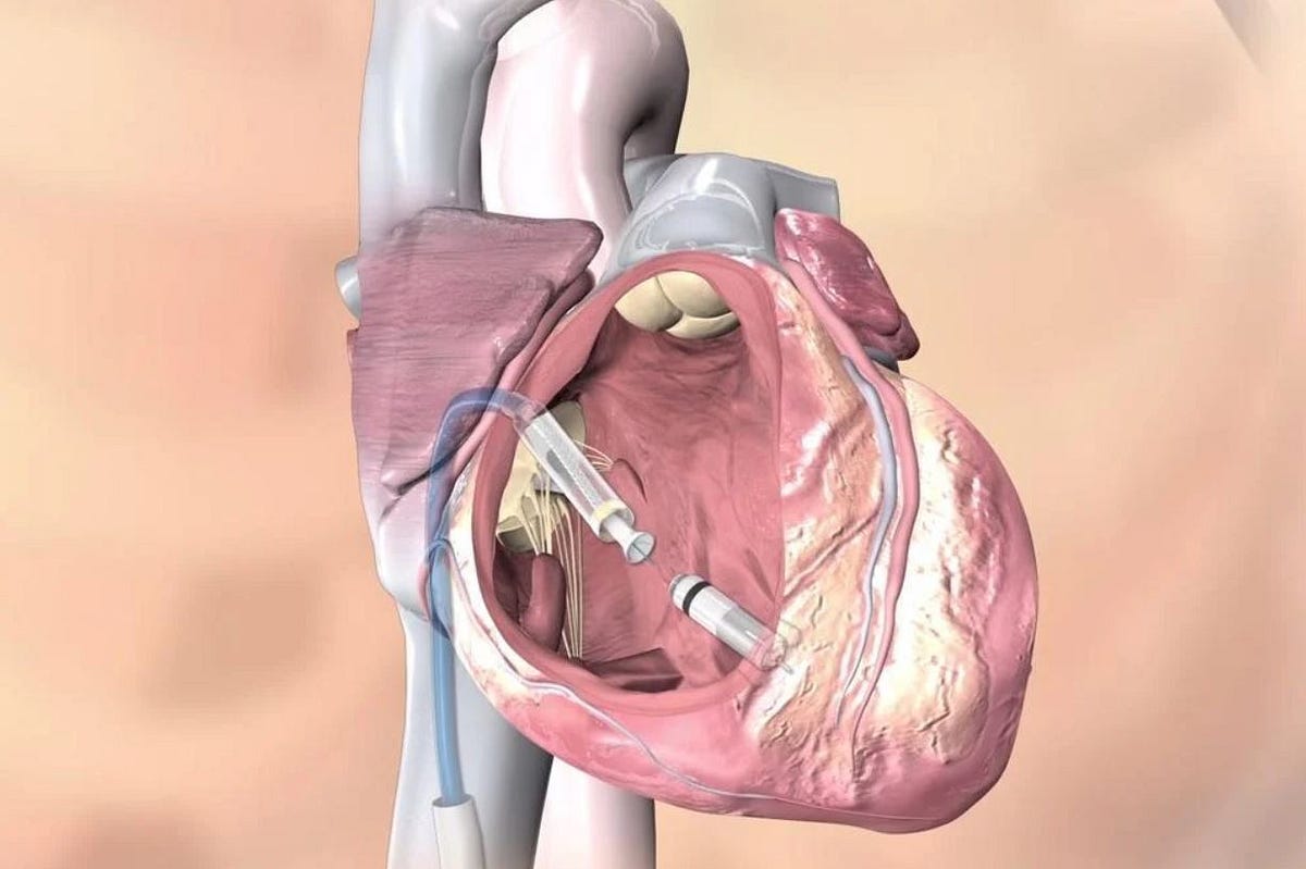 “leadless” Cardiac Pacemakers Patient9 Medium