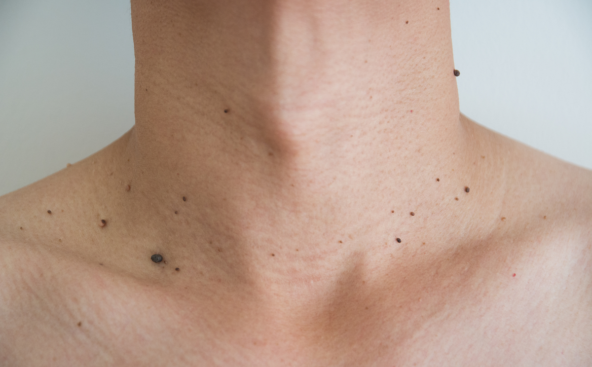 Skin Tags are Yucky but Usually Harmless, Unless You…