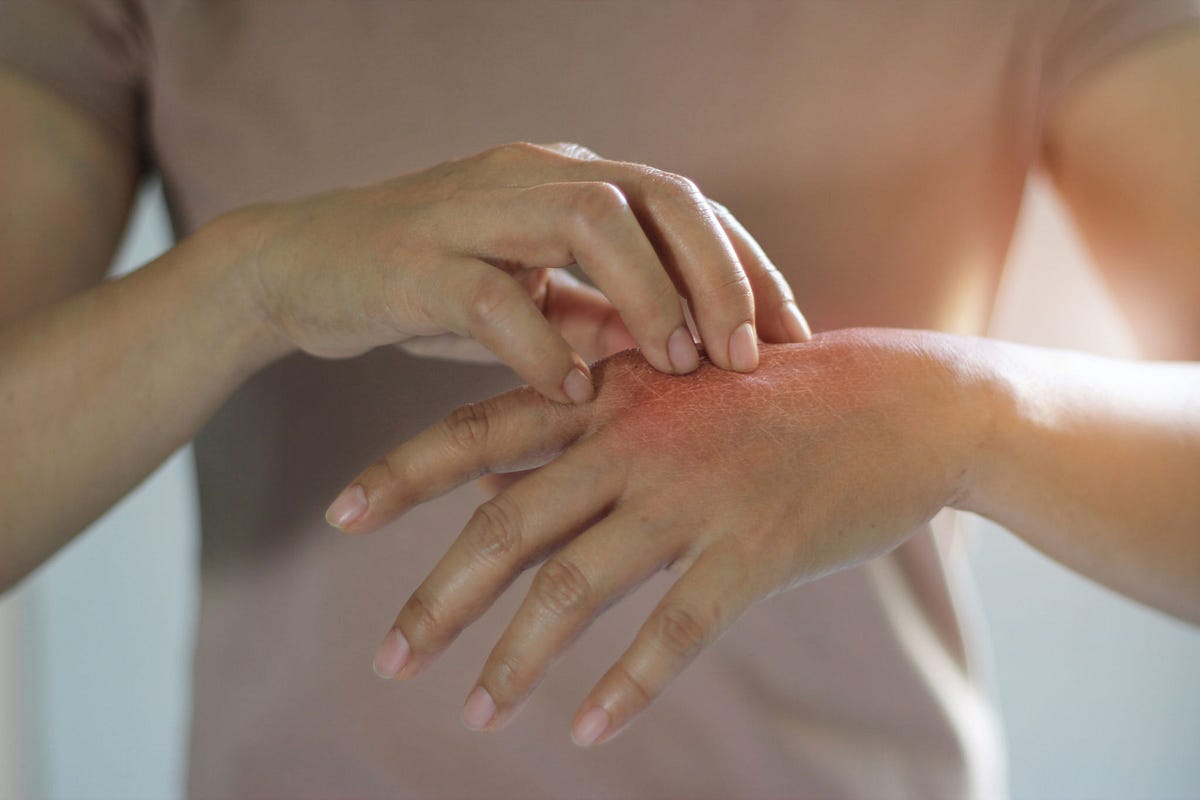 How to Cure Fungal Infection on Skin Naturally 10 Proven Remedies by