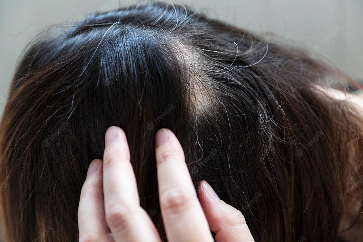 diseases-that-cause-hair-loss-what-you-need-to-know-by-metropolmed