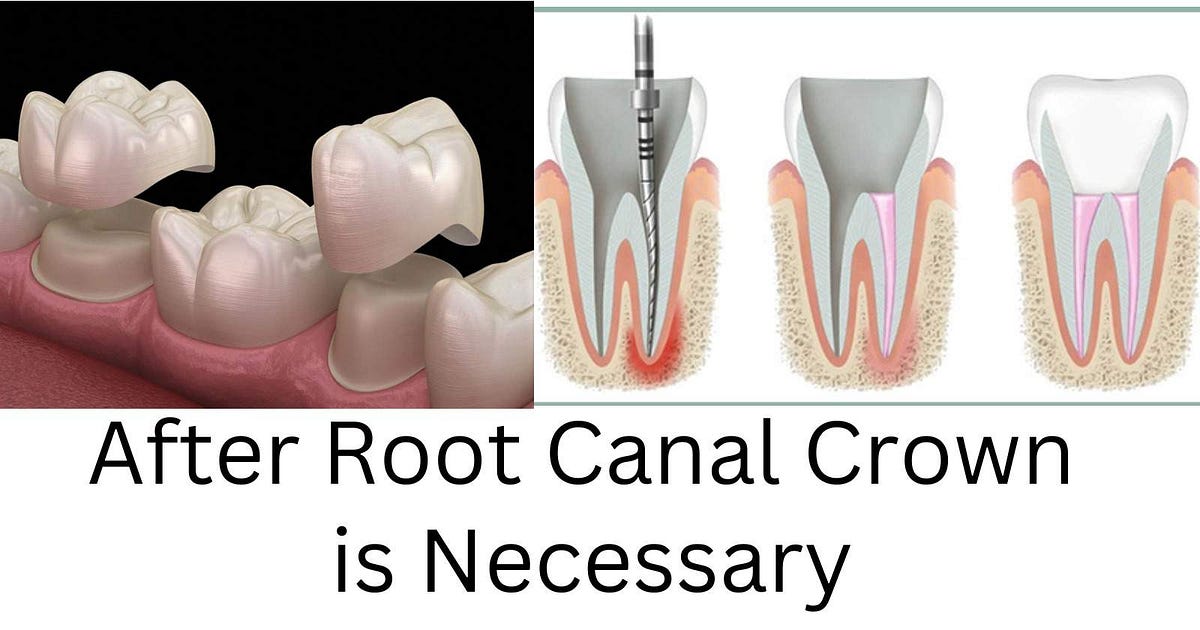 Teeth Cap Price Unveiling the Costs of Dental Crowns by Center for Dental Implants