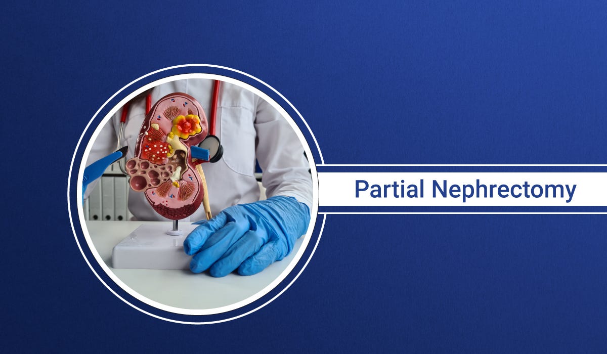 Everything To Know About Partial Nephrectomy by Saketnarnoliurologist