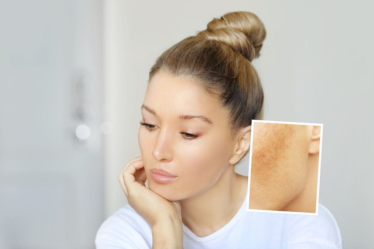 How To Get Rid Of Spots And Black Dots On The Face By Luisa Vazquez how-to-get-rid-of-spots-and-black-dots-on-the-face-by-luisa-vazquez