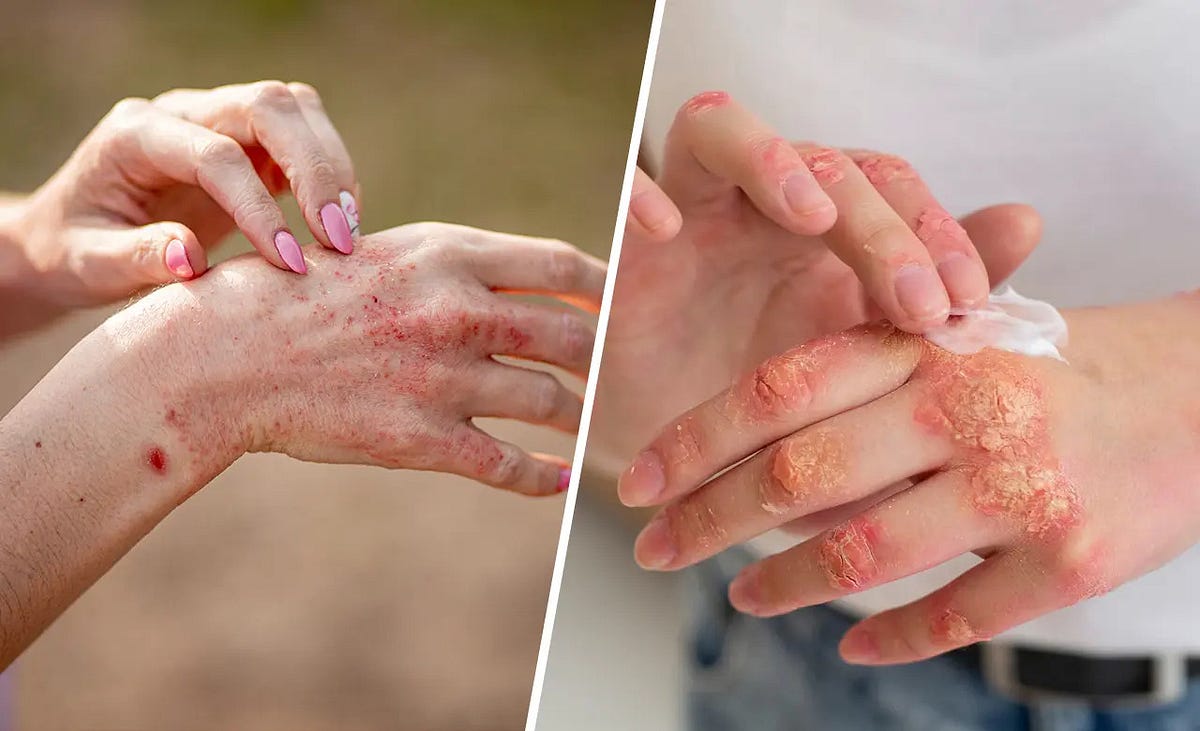 The Skin Chronicles: Unraveling the Differences in Symptoms and 