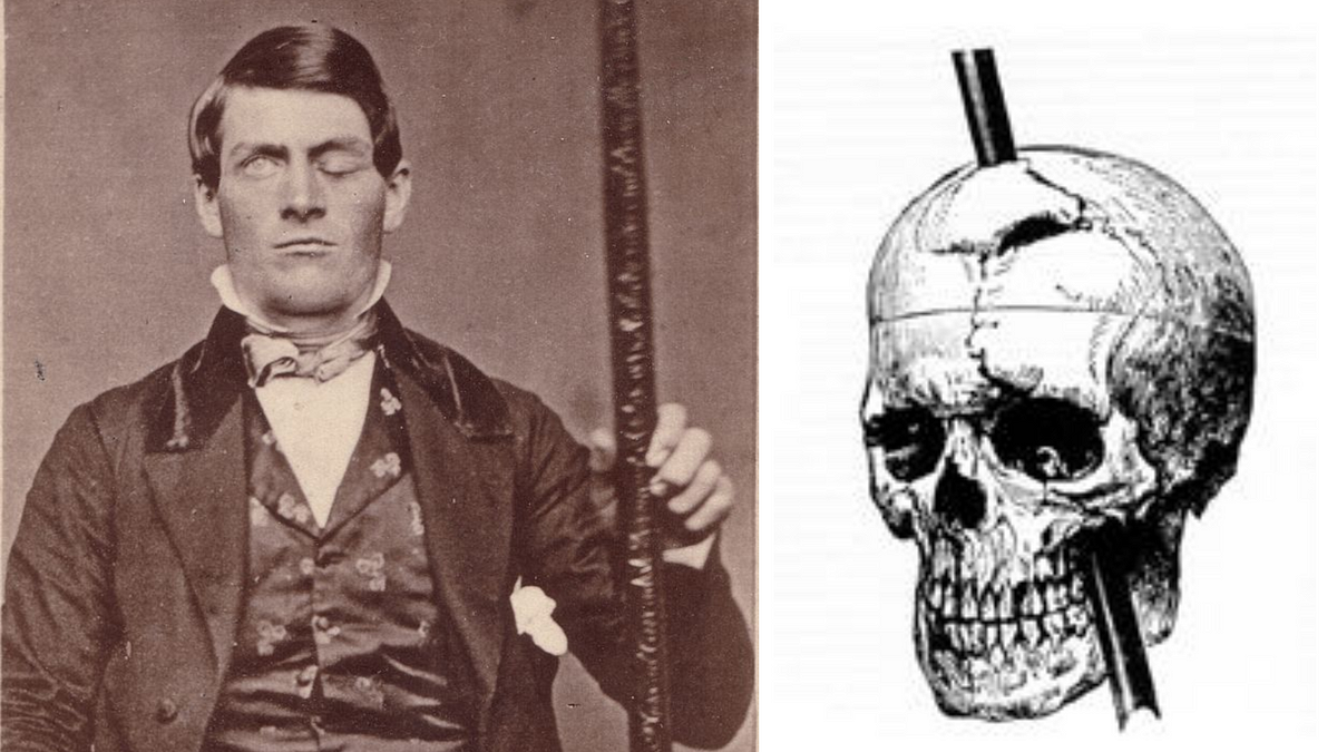 case study of phineas gage summary