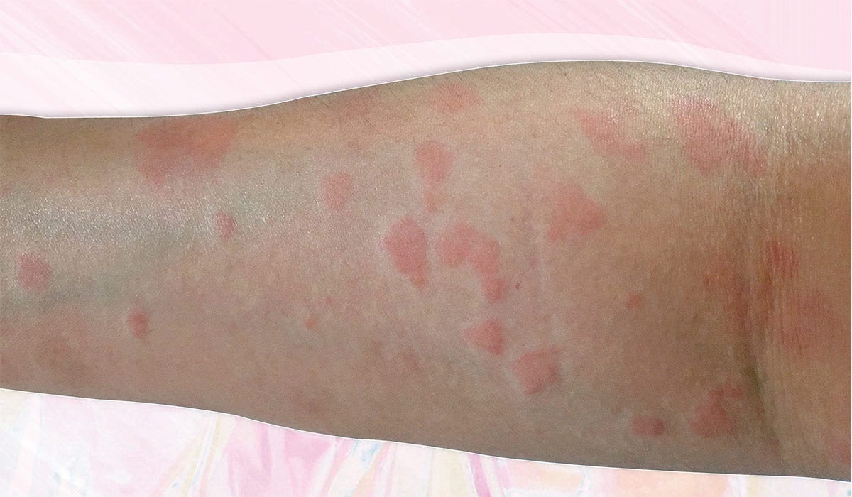 What Is Lupus and How Does It Affect the Skin?
