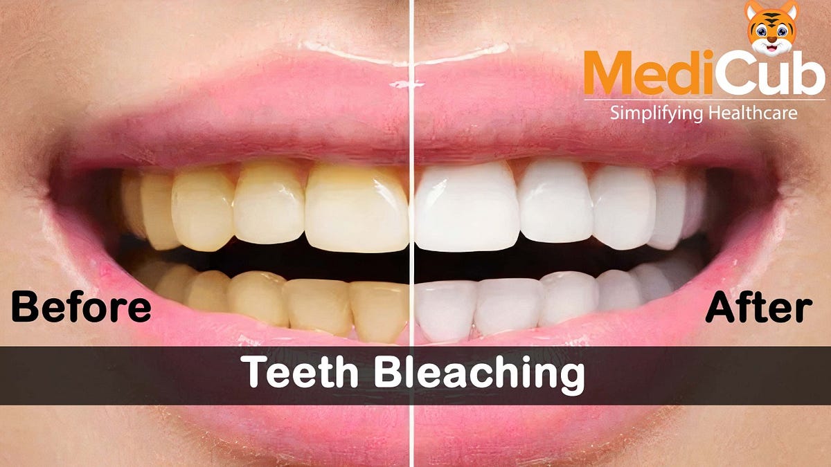 Teeth Bleaching. Tooth whitening or Dental bleaching is… by