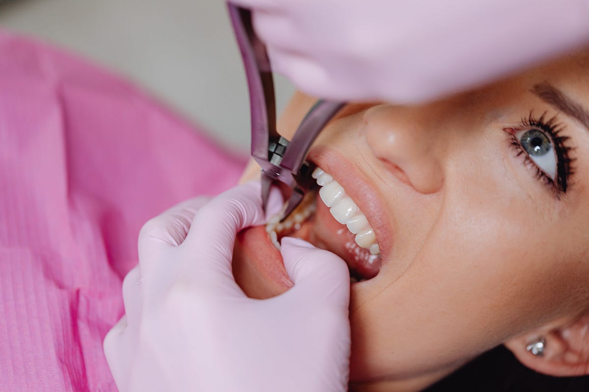 Tooth Extraction Understanding the Procedure and Recovery by