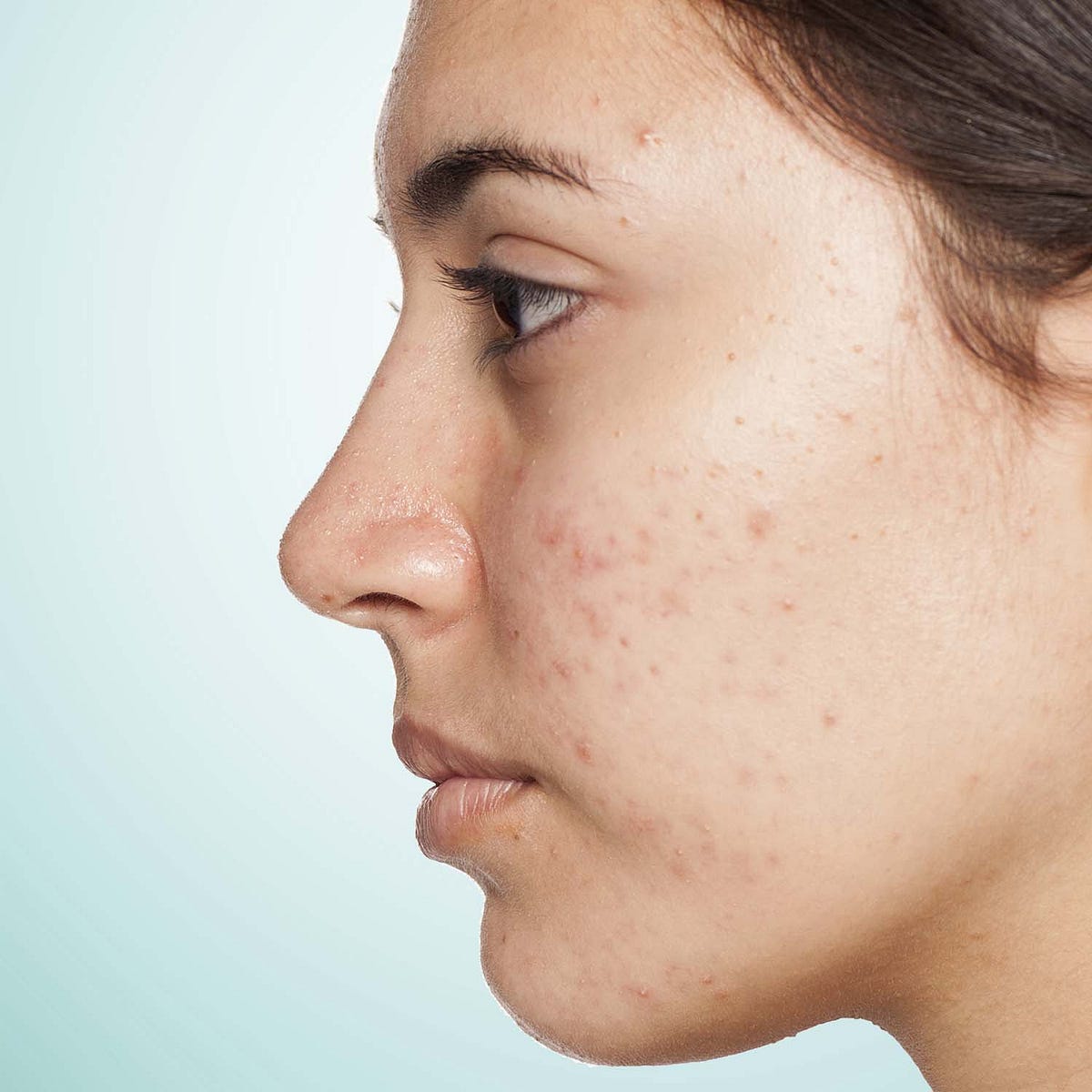 Improve the Appearance of Scars with These 5 Tips by William Medium