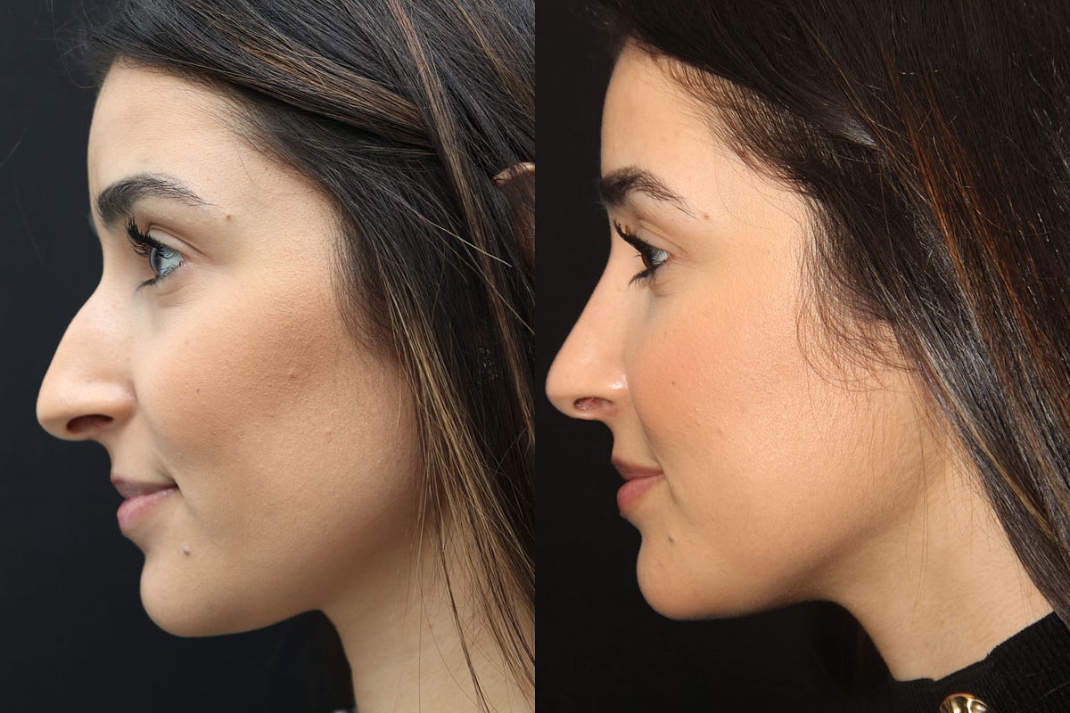Rhinoplasty Myths Debunked: Separating Fact from Fiction by
