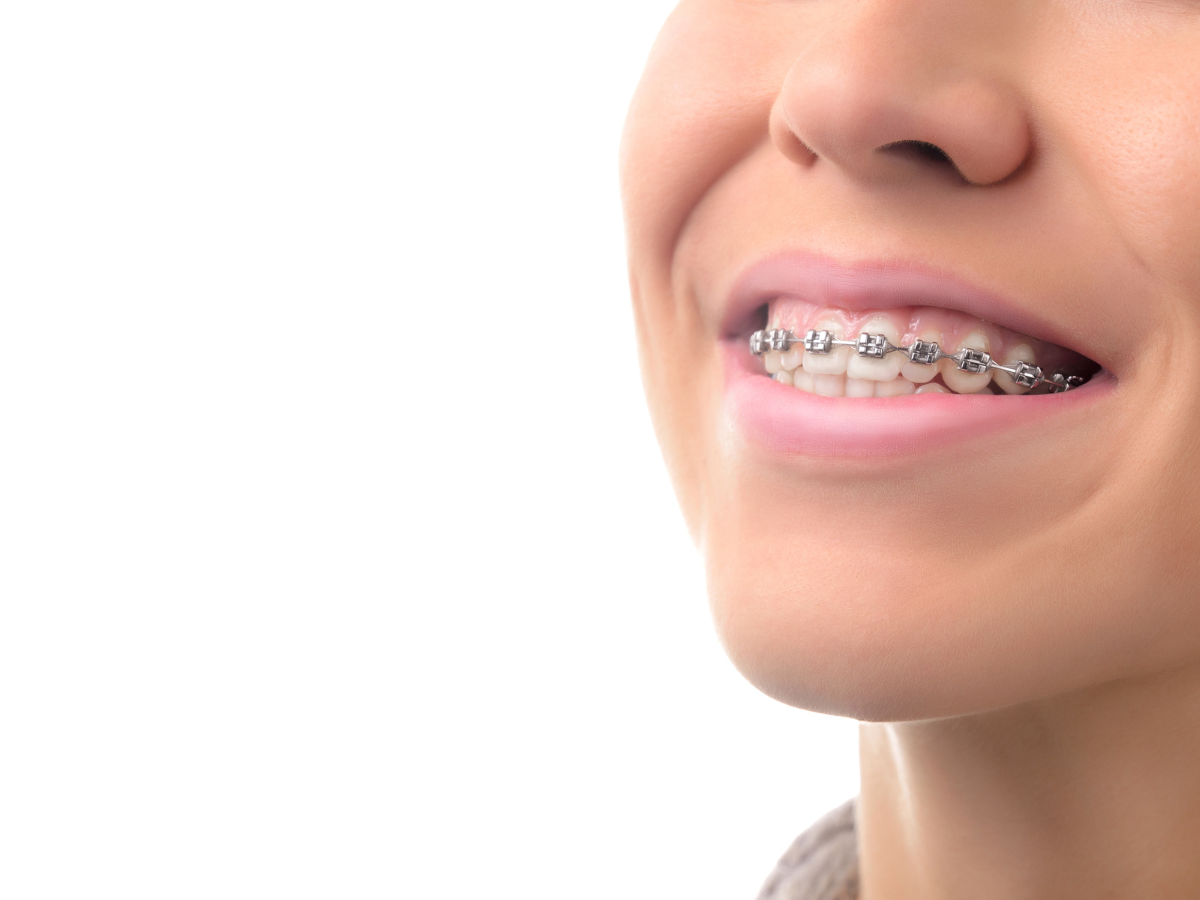 Braces cost in charlotte.. Charlotte b Goldsmith Orthodontics… by