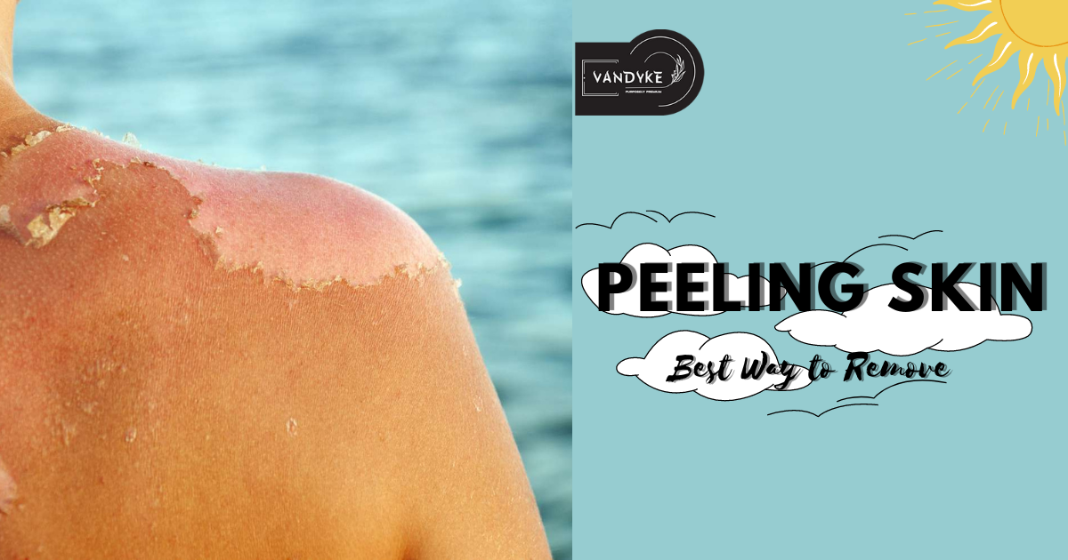 Best Way to Remove Peeling Skin vandykeindia Medium