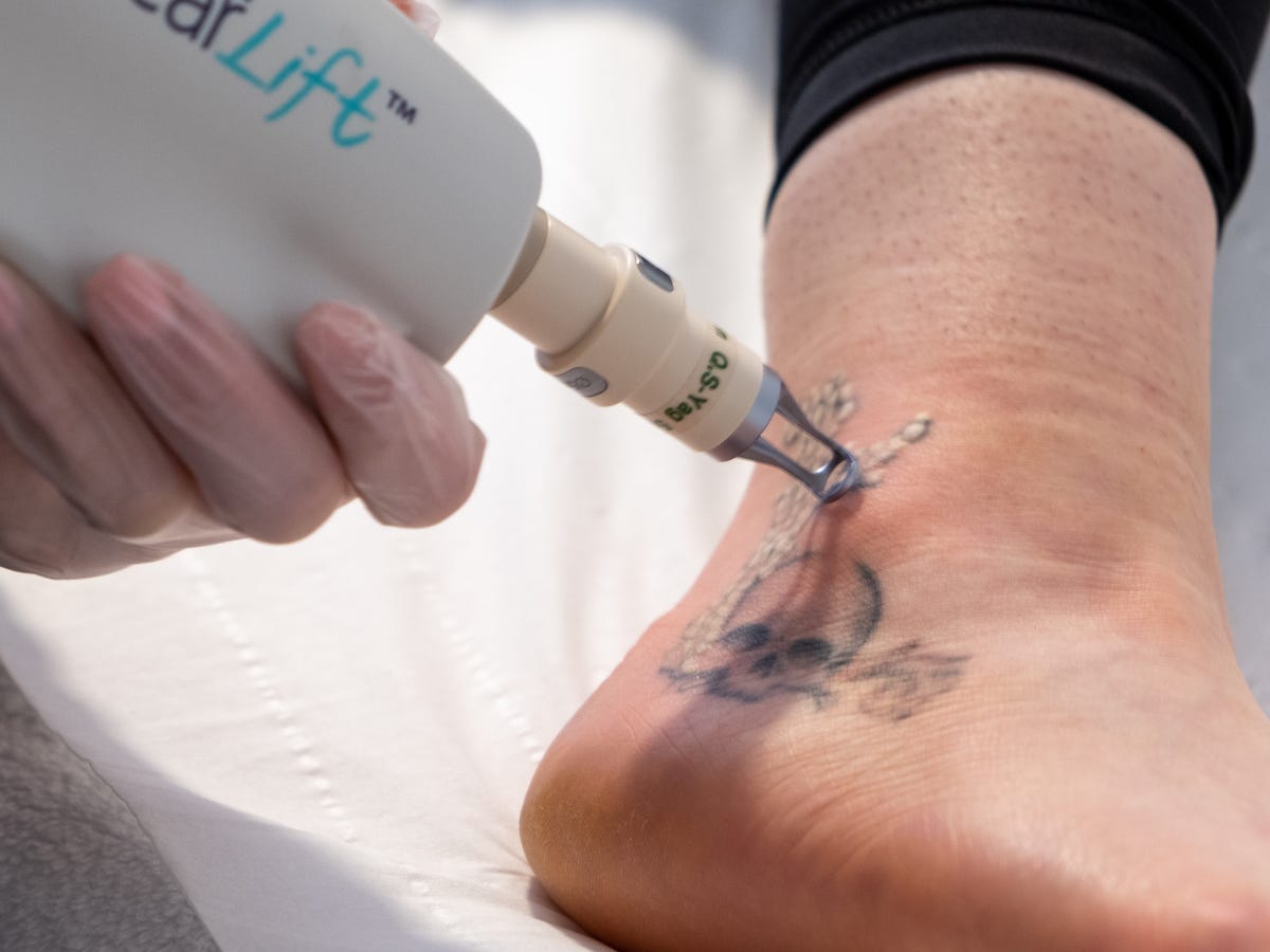 Dubai's Ink Liberation: How Laser Tattoo Removal is Reshaping Identities | by Khurram Dynamicclinic | Medium