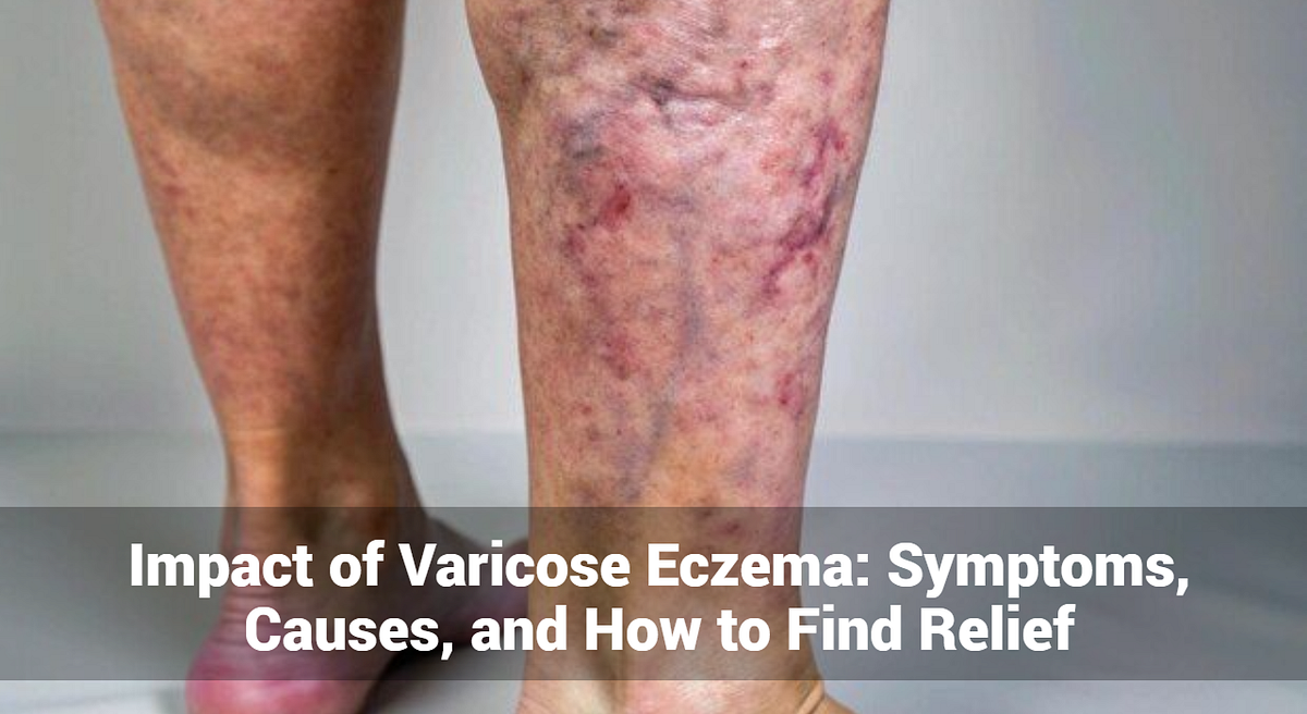 Varicose Eczema Symptoms Eczema Variqueux D finition XNTT Varicose Eczema Symptoms Eczema Variqueux D finition XNTT