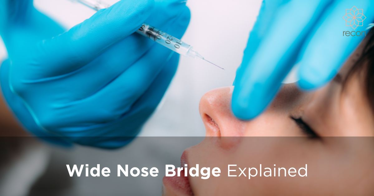 Bridging Beauty The Unique Impact of a Wide Nose Bridge by Recon