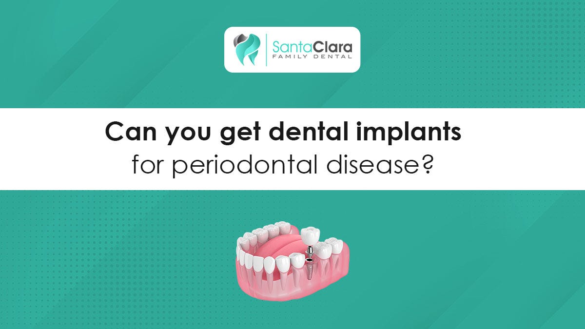 Dental Implants for Periodontal Disease: What You Need to Know | by ...