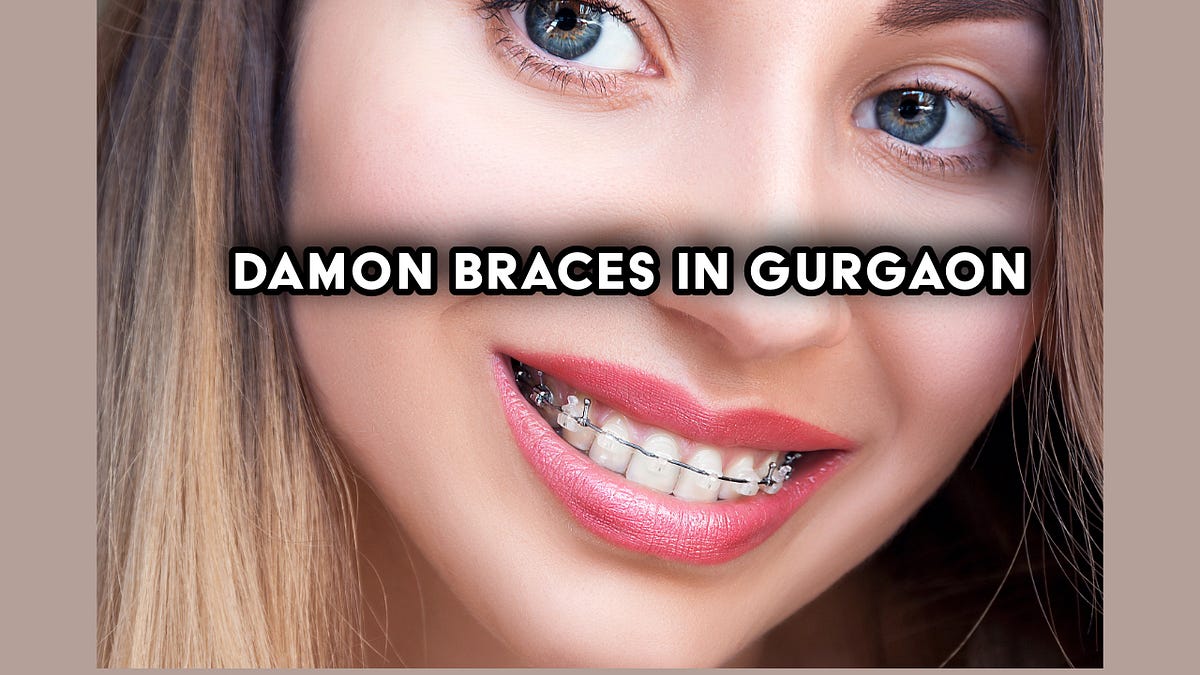 Damon Braces in Gurgaon. Understanding Damon Braces in Gurgaon by