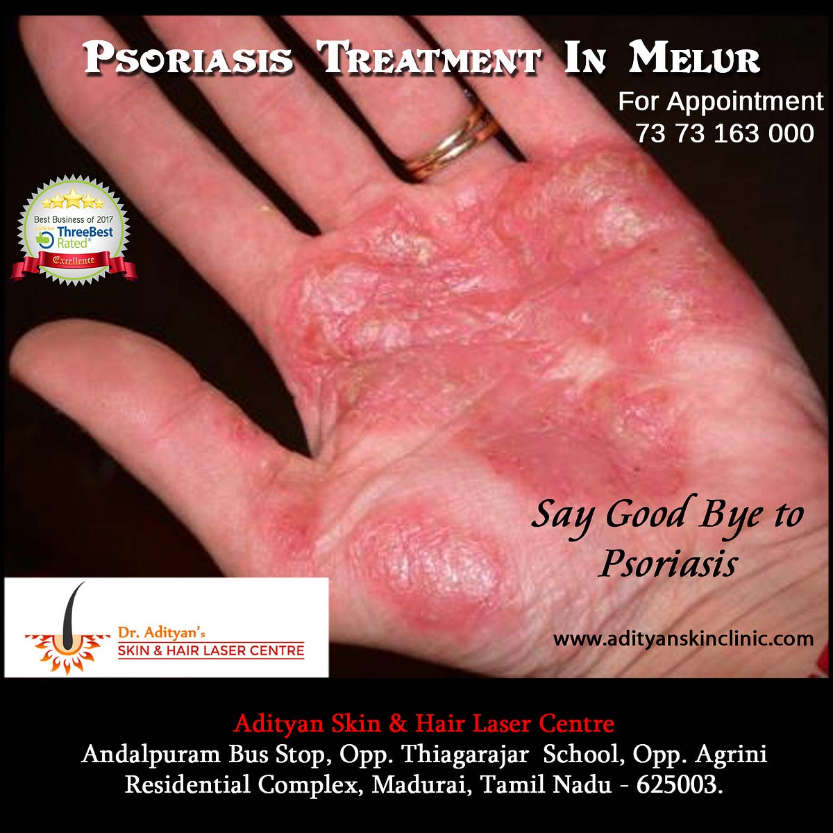 How Can Psoriasis Flareups Be Prevented? by raveenaraj Medium