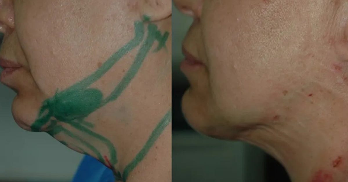 Stunning Results: Neck Liposuction Before and After Images