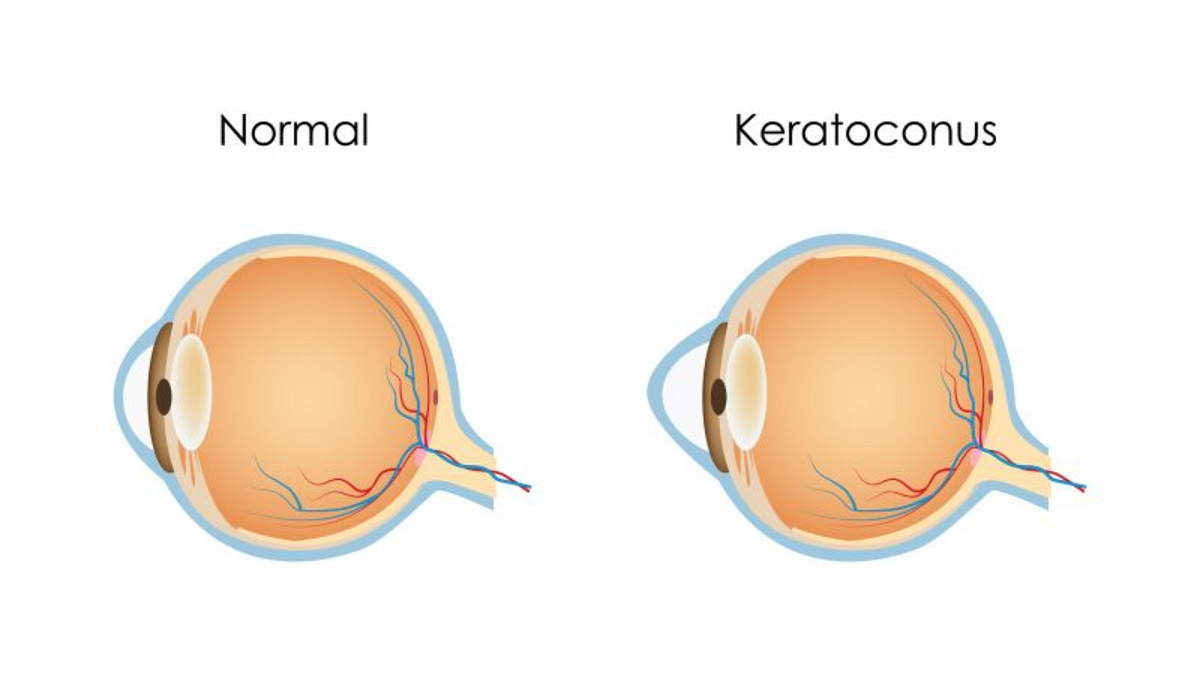 Keratoconus A Guide To Symptoms Causes And Care By