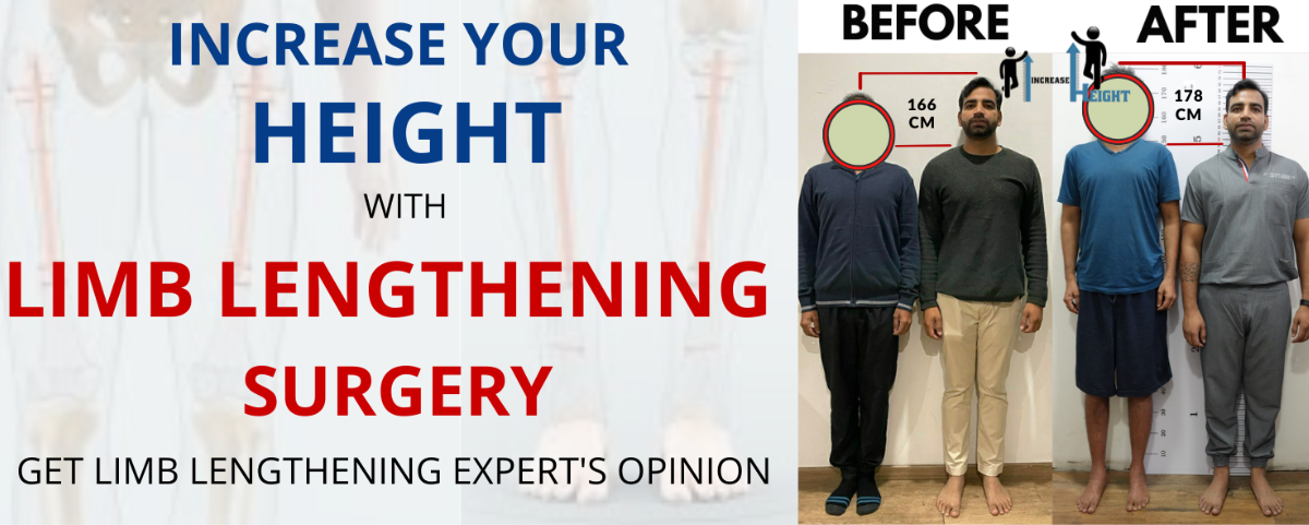 Limb Lengthening Surgery in India The Process Explained by