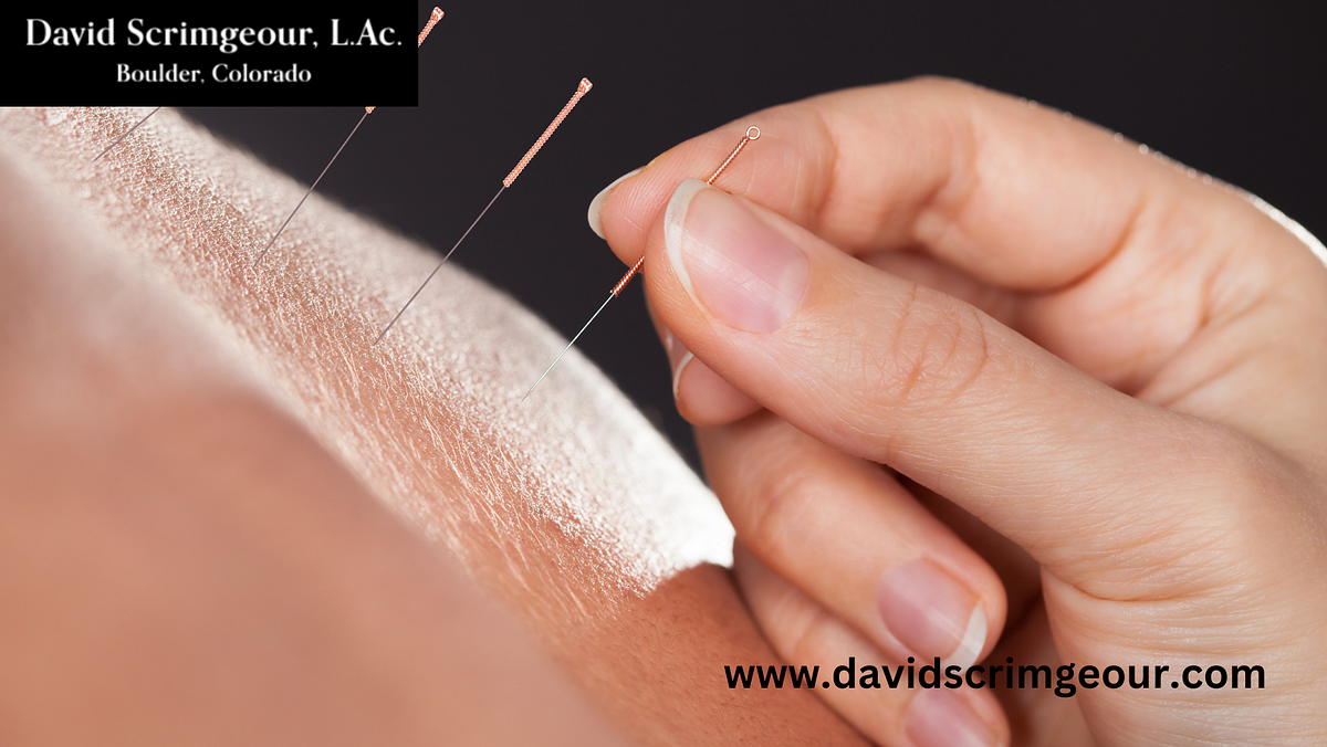 Balancing Life & WellBeing The Acupuncture Approach in Boulder