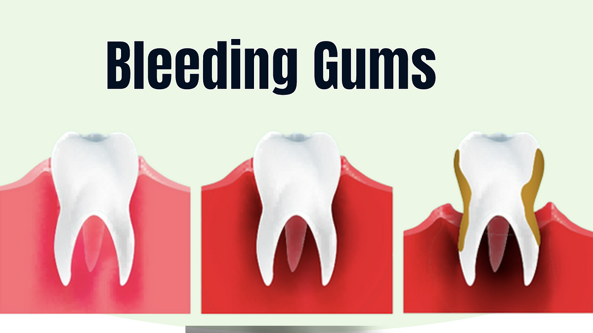 Bleeding Gums — Causes Prevention And Treatment By Ashley Durack