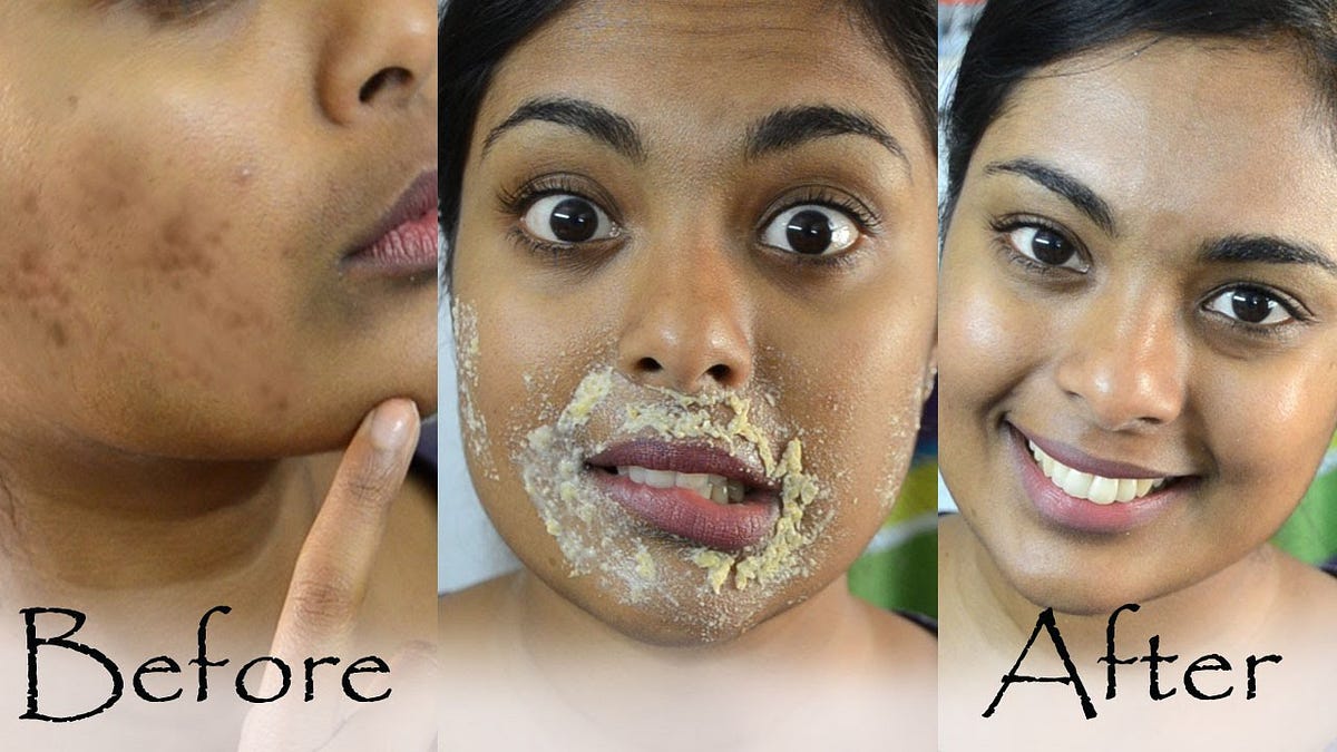 How To Remove Dark Spots On Face Fast Naturally Danialkareemghori Medium