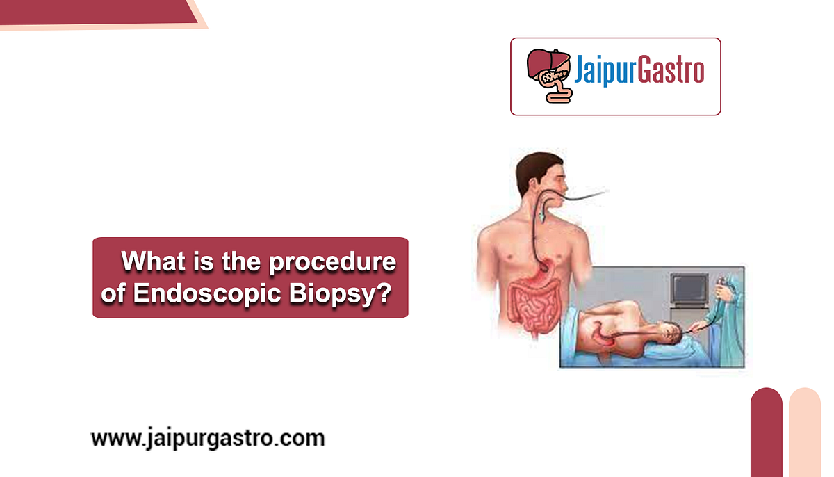 What is the procedure of Endoscopic Biopsy? by jaipur gastro Medium