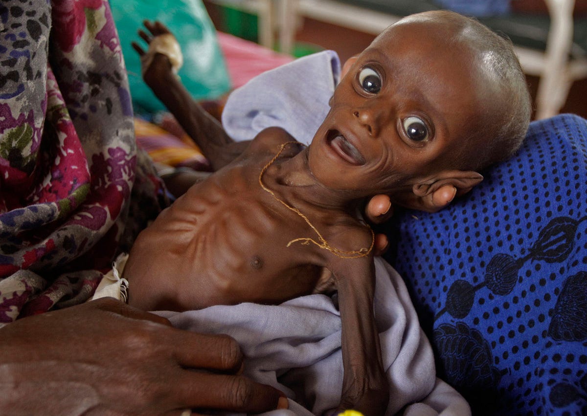 Suffering Children In Africa Suffering Children In Africa
