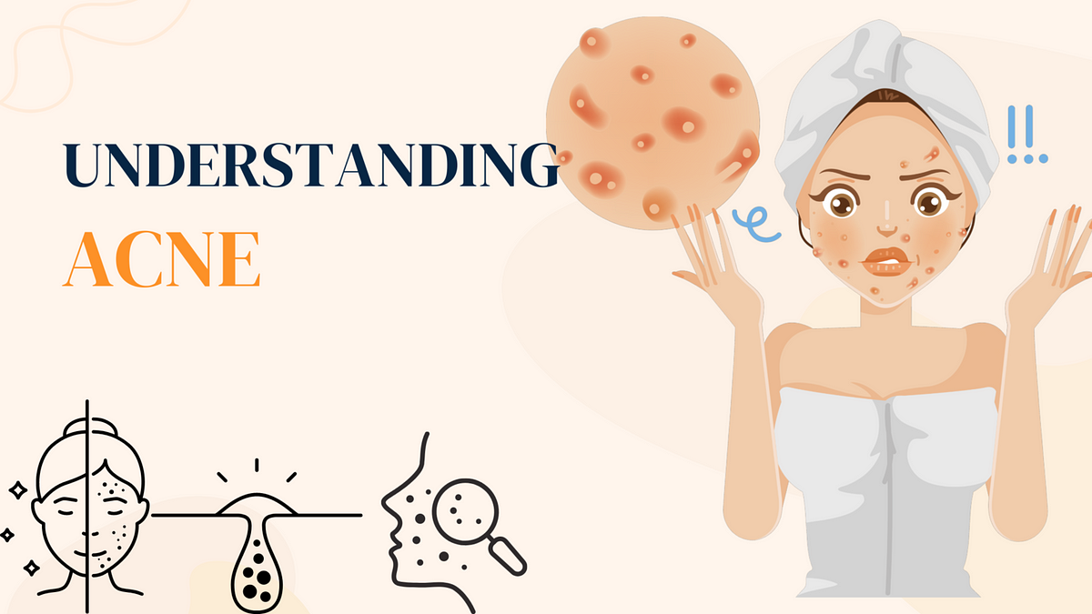 Banishing Breakouts: Your Comprehensive Guide to Dealing with Acne  by 