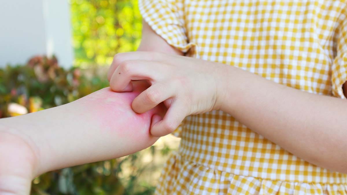 Seasonal Rashes Can Be Treated With These 7 Simple Home Remedies by