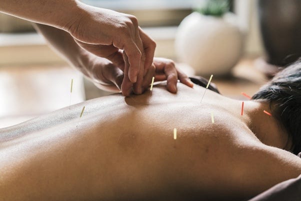 Can you do acupuncture on Yourself? | by Shiv Smt Center | Medium
